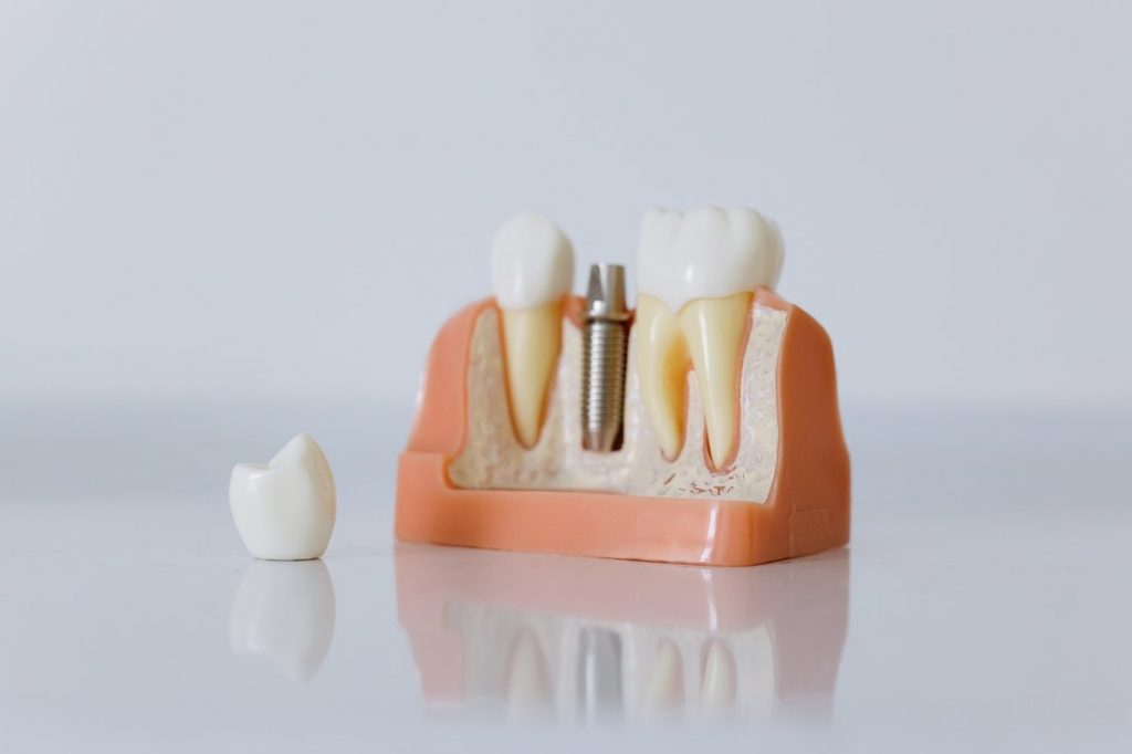 zubni implanti stoje na stolu
